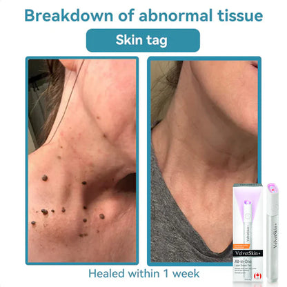 🇨🇦 Bikenda® VelvetSkin+ All-in-One Laser Eraser Pen(Powered by CO₂ laser technology – effectively removes moles, warts, skin tags, pigmentation spots, and other skin imperfections)