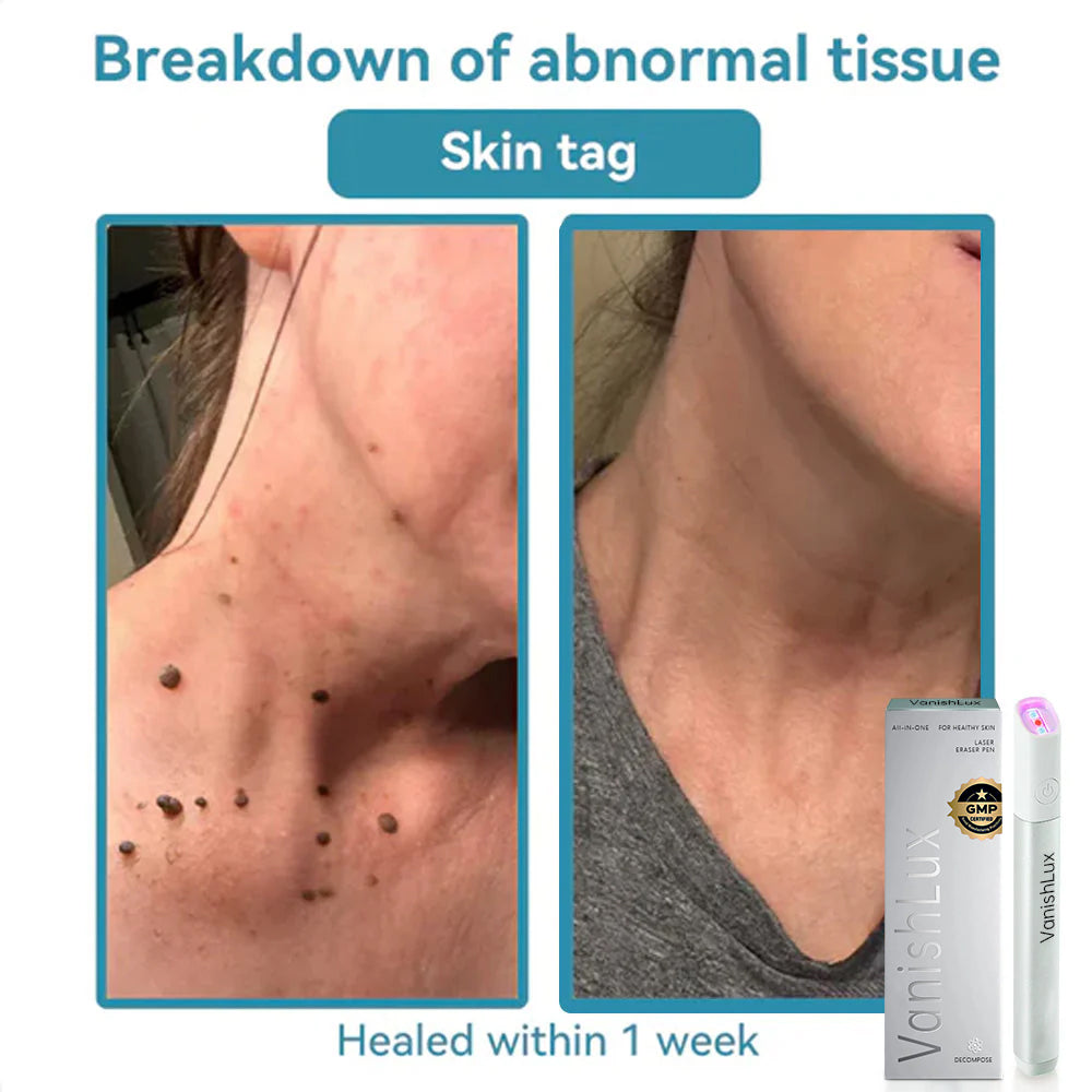 🇨🇦 Bikenda® VanishLux All-in-One Laser Eraser Pen(Powered by CO₂ laser technology – effectively removes moles, warts, skin tags, pigmentation spots, and other skin imperfections)