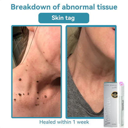 🇨🇦 Bikenda® VanishLux All-in-One Laser Eraser Pen(Powered by CO₂ laser technology – effectively removes moles, warts, skin tags, pigmentation spots, and other skin imperfections)