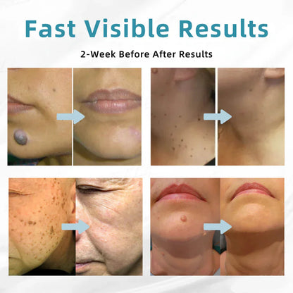 🇨🇦 Bikenda® VanishLux All-in-One Laser Eraser Pen(Powered by CO₂ laser technology – effectively removes moles, warts, skin tags, pigmentation spots, and other skin imperfections)