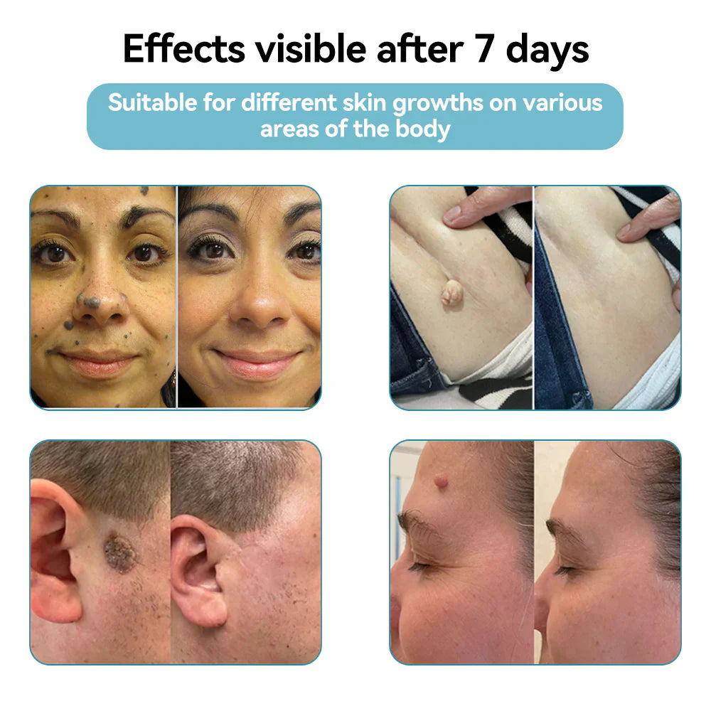 🇨🇦 Bikenda® VanishLux All-in-One Laser Eraser Pen(Powered by CO₂ laser technology – effectively removes moles, warts, skin tags, pigmentation spots, and other skin imperfections)