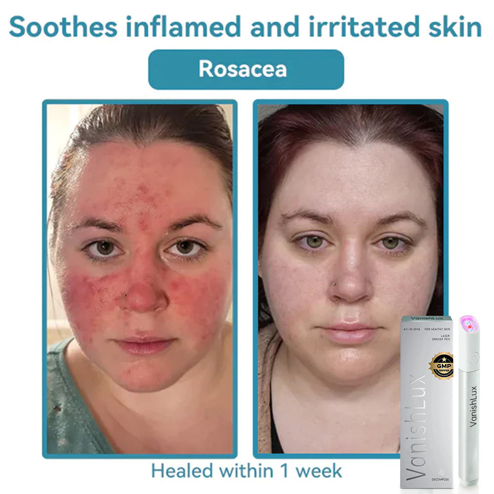 🇨🇦 Bikenda® VanishLux All-in-One Laser Eraser Pen(Powered by CO₂ laser technology – effectively removes moles, warts, skin tags, pigmentation spots, and other skin imperfections)