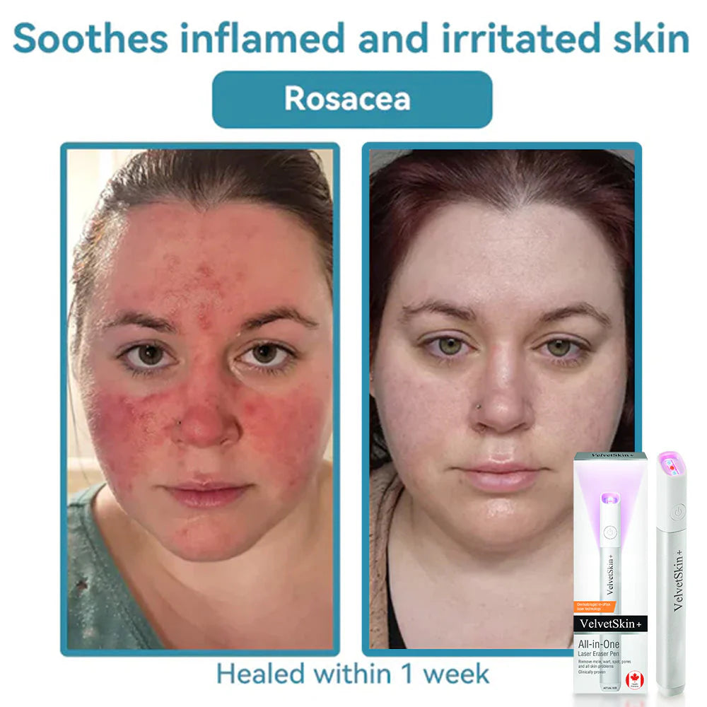 🇨🇦 Bikenda® VelvetSkin+ All-in-One Laser Eraser Pen(Powered by CO₂ laser technology – effectively removes moles, warts, skin tags, pigmentation spots, and other skin imperfections)