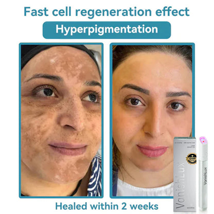 🇨🇦 Bikenda® VanishLux All-in-One Laser Eraser Pen(Powered by CO₂ laser technology – effectively removes moles, warts, skin tags, pigmentation spots, and other skin imperfections)