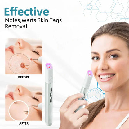 🇨🇦 Bikenda® VanishLux All-in-One Laser Eraser Pen(Powered by CO₂ laser technology – effectively removes moles, warts, skin tags, pigmentation spots, and other skin imperfections)