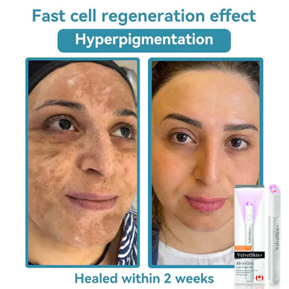 🇨🇦 Bikenda® VelvetSkin+ All-in-One Laser Eraser Pen(Powered by CO₂ laser technology – effectively removes moles, warts, skin tags, pigmentation spots, and other skin imperfections)