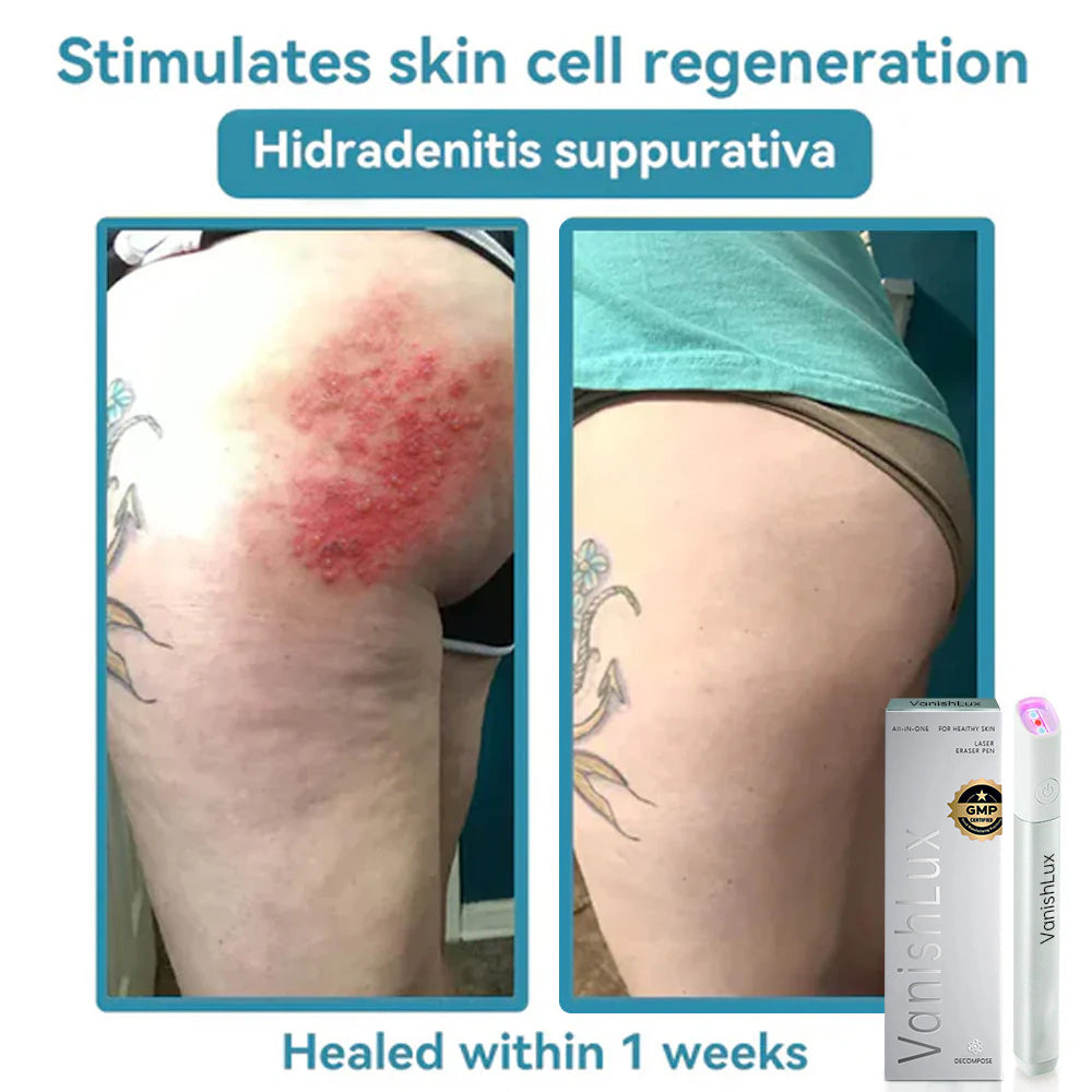 🇨🇦 Bikenda® VanishLux All-in-One Laser Eraser Pen(Powered by CO₂ laser technology – effectively removes moles, warts, skin tags, pigmentation spots, and other skin imperfections)
